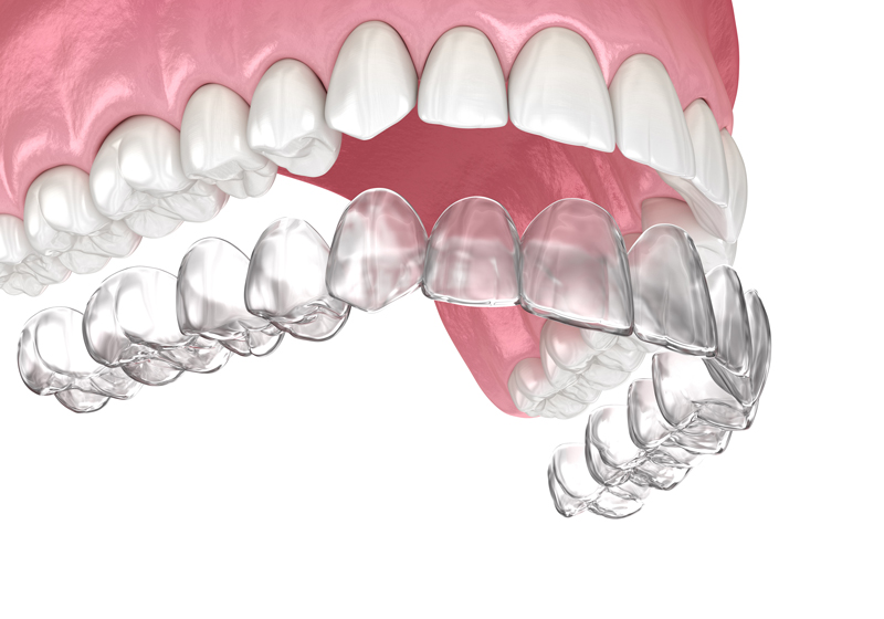 Van_den_Goorbergh_orthontie_brackets_1